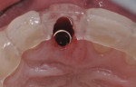 Position of the buccal implant shoulder 1 mm deeper than the buccal height of bone.