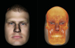 Figure 9  Superimposition of conventional digital photograph over CBCT scan (pictured on InVivoDental).