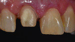 Fig 2. The old composite restoration is removed and the tooth prepared.
