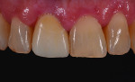 Fig 1. Preoperative view of a patient who presented with a large fracture and discolored composite restoration on tooth No. 8.