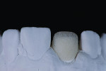 Fig 14 through Fig 17. IPS e.max Ceram Deep Dentine powder is used according to the “salt-and-pepper” technique to opacify the coping, as well as contribute to light reflection.