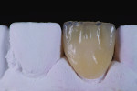 Fig 19. A variety of effects powders are used to recreate the natural characteristics of the patient’s tooth structure.
