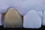 Fig 18. The restoration is built up by first applying IPS e.max Ceram Powder Dentine in shade A3, which contributes to chroma, saturation, and value.