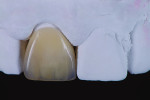 Fig 24. After glazing and polishing, the anterior crown restoration demonstrates the desired surface texture.