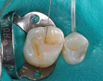 Figure 6  Brown tint applied with a small endodontic file.