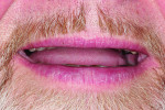 Fig 2. Close-up view highlights the lack of maxillary anterior tooth structure.