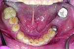 Fig 6. Pretreatment view of the mandibular arch; note the wear and the flat anatomy on the amalgam restorations.