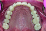 Fig 16. Post-treatment maxillary view.