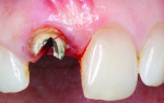 Fig 1. Preoperative intraoral view of the maxillary right central incisor.