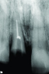 Fig 2. Preoperative periapical radiograph.