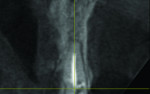 Fig 3. CBCT transversal view of the maxillary right central incisor.