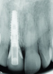 Fig 6. Postsurgical periapical x-ray showing an ideal 3D immediate implant placement with a screw-retained provisional crown.