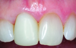 Fig 7. Provisional crown 5 months after insertion.