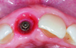 Fig 8. Thick soft tissue on the buccal side of the implant for optimized esthetics.