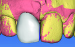 Fig 10 and Fig 11. The design software created a copy of the contralateral tooth and matched it to the existing space; buccal
view (Fig 10) and incisal view (Fig 11).