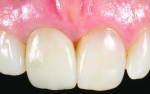 Fig 13. Postoperative view of the implant-supported ZLS ceramic CAD/CAM crown in the area of the maxillary right central incisor.