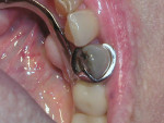 Figure 1  Recurrent caries and a fractured lingual cusp and amalgam on tooth No. 28 was evident on the preoperative photograph.