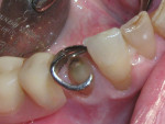 Figure 2  The RPD was placed in the mouth to ensure adequate reduction after tooth preparation.