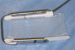 Figure 3  The paper corner of the insert was removed to prevent interference with the anterior teeth and soft tissue.