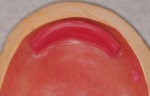 Fig 3. Maxillary thin wax rim.