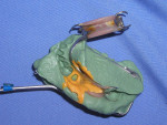 Figure 6  The impression and the RPD were removed in one piece.