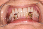 Figure 10  After preparation of both teeth, the RPD was inserted in the mouth and the reductions were verified.