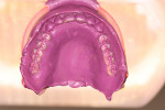 Figure 12  The opposing maxillary denture and the mandibular RPD appear to have been in intimate contact.