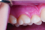 ￼Fig 2. Pretreatment sensitivity site, tooth No. 3 cervical.