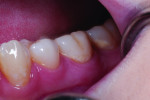 Fig 3. Pretreatment sensitivity site, tooth No. 19 cervical.