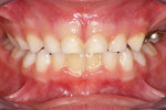 Figure 3  Visible plaque on child’s teeth.