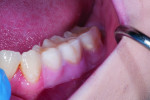 Fig 5. Oxalate strip, mandibular left posterior after 5 minutes.