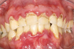 Figure 4  Visible cavitations, white-spot lesions, and plaque on an adult’s teeth.