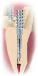 Figure 1  Illustration of the graduated tap design of the Flexi-Post, which minimizes the insertional stresses while distributing those small stresses evenly along the length of the engaged canal.