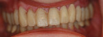 Fig 6 and Fig 7. The wax-up was duplicated and poured, followed by the creation of a silicone matrix used to translate the wax-up information to the oral environment and fabricate acrylic provisionals intraorally after the tooth structure was reduced.