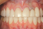 Figure 2  The provisional restoration on the maxillary anterior segment.