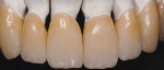 Fig 19. A combination of staggering enamel and translucency was incorporated and layered on the anterior teeth.