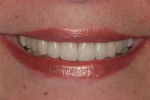 The finished case showing reconstructed smile.