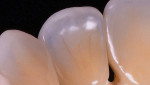 Fig 8 and Fig 9. Blue stain is applied on the facial incisal edge except on the centrals.