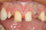 Figure 4  A pre-retraction view after removal of the provisional restorations.