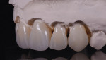 Fig 8 and Fig 9. Blue stain is applied on the facial incisal edge except on the centrals.