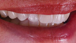 Fig 12 through Fig 14. The final result of the KATANA zirconia UTML crowns.