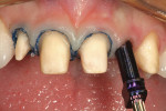 Figure 5  Retraction cords and implant impression coping in place.
