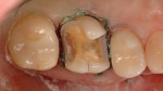Removal of existing restoration and diseased dentin.