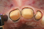 Figure 7  Retracted tissue before placement of the Aquasil Ultra Xtra light-body impression material.