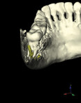 Impacted tooth No. 17 in close proximity to inferior alveolar nerve, 25-year-old woman. A
visualization of this type would be impossible with standard 2D imaging. As opposed to extraction of No. 17, a coronectomy procedure was performed, minimizing potential paresthesia.