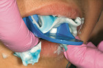 Figure 10  Placement of the loaded impression material in the patient’s oral cavity.
