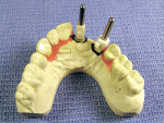 Figure 5  Ceramic Guide Sleeves placed on guide posts, brackets rotated toward the palatal surface.