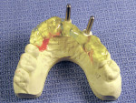 Figure 6  Triad Gel capturing guide sleeve brackets and applied to the palatal and incisal surfaces of the adjacent teeth.