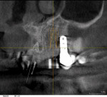 Figure 8  Acceptable tangential radiographic image with ceramic guide sleeve in place.