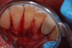 Fig 3. Flap of anterior central incisors of patient in Figure 1 revealed calculus and bone loss. The calculus most likely could not be removed without surgical intervention.
